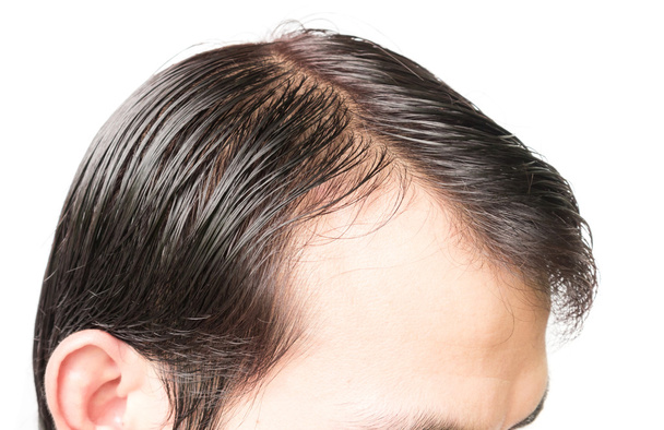 Nahaufnahme junger Mann ernstes Haarausfall-Problem für Haarausfall-Konzept - Foto, Bild