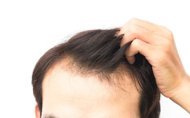 Closeup young man serious hair loss problem for hair loss concept - Foto, imagen