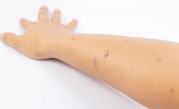 Blister sul braccio della pelle
 - Foto, immagini