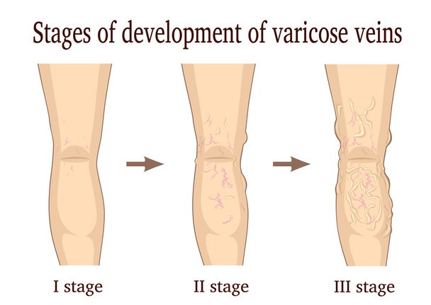 Stages of development of varicose veins - Vector, Image