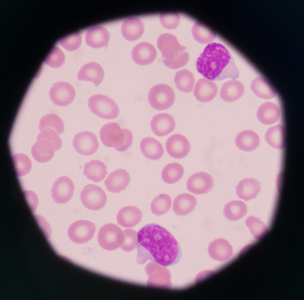 вибухові клітини на периферійних зображеннях крові
. - Фото, зображення