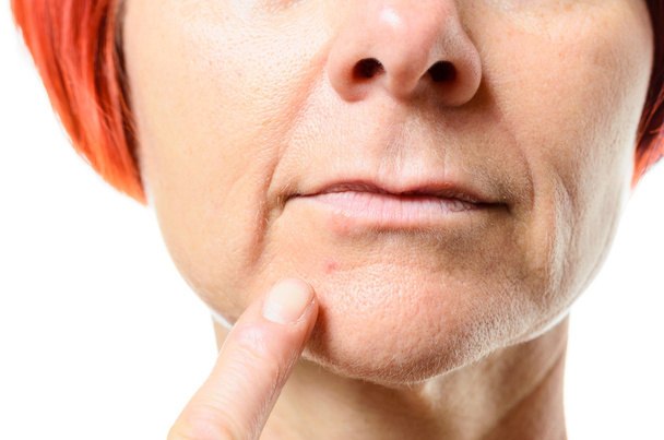 Woman pointing to blemish on chin - Fotoğraf, Görsel