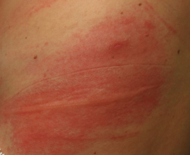 Kiütés érzékeny bőr vagy allergiás kiütés a bőr probléma - Fotó, kép