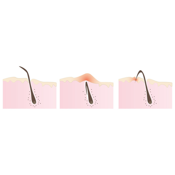 struktura vlasového folikulu, zarůstání chloupků po holení a depilaci - Vektor, obrázek