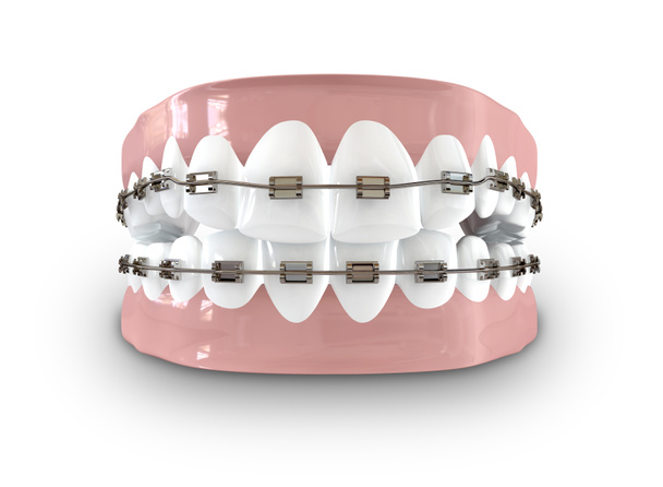 Dents munies d'attelles
 - Photo, image