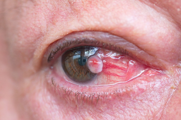 Nahaufnahme des Plattenepithelkarzinoms der Augenkonjunktiva - Foto, Bild