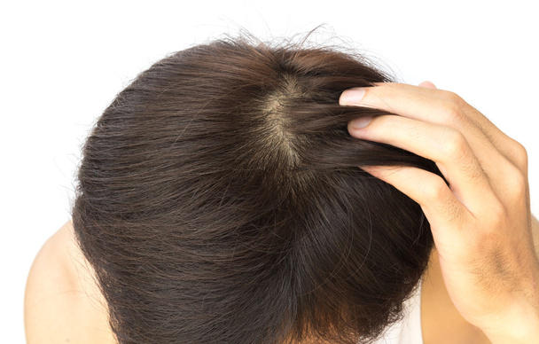 Νεαρό άνδρα σοβαρό πρόβλημα της τριχόπτωσης για έννοια απώλεια μαλλιών - Φωτογραφία, εικόνα