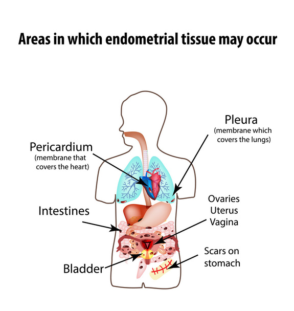 Zones dans lesquelles des tissus endométriaux peuvent apparaître. Endométriose. Endométriose dans le corps. La structure des poumons, du cœur, de l'intestin, de l'estomac, du foie, des organes pelviens. Silhouette. Infographie vectorielle
 - Vecteur, image