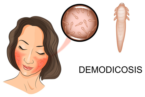 το πρόσωπο της γυναίκας επηρεάζεται από δεμοδήκωσης. Demodex άκαρι κάτω από mag - Διάνυσμα, εικόνα