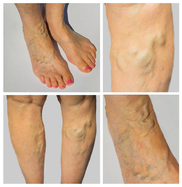 Варикозне розширення вен на ногах жінки
 - Фото, зображення