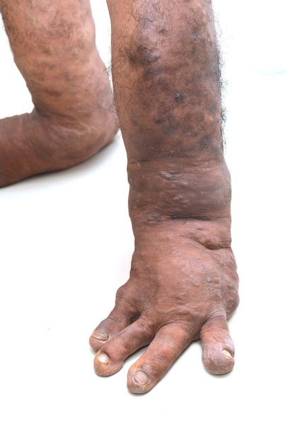 Trastornos del pie desde el nacimiento, como filariasis. enfermedades óseas
 - Foto, imagen