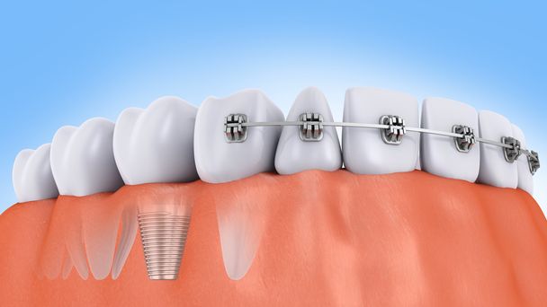dents et implant
 - Photo, image