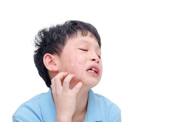 chłopiec drapanie twarzy alergii - Zdjęcie, obraz