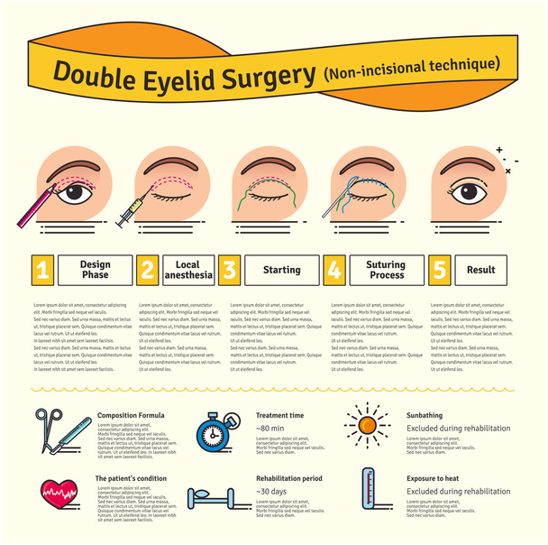 Vektor illustriertes Set mit doppelter Augenlidchirurgie. nicht inzisionale Technik - Vektor, Bild