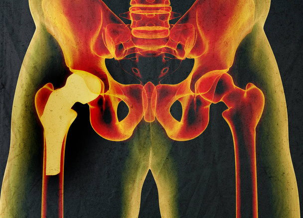 Hip replacement model - Photo, Image