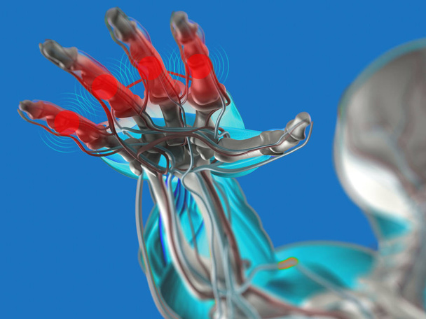 Hand-Anatomie-Modell mit Arthritis - Foto, Bild
