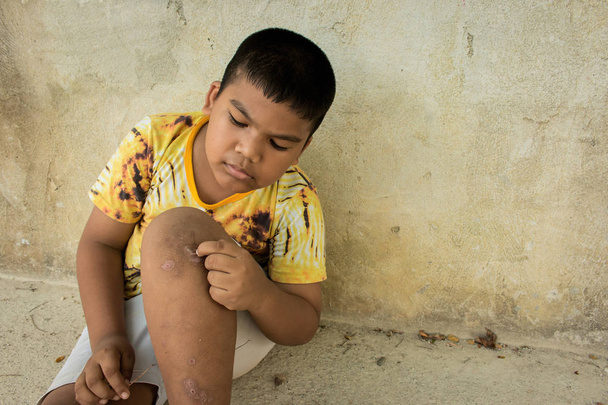 少年の足に水疱かさぶたをスクラッチ - 写真・画像