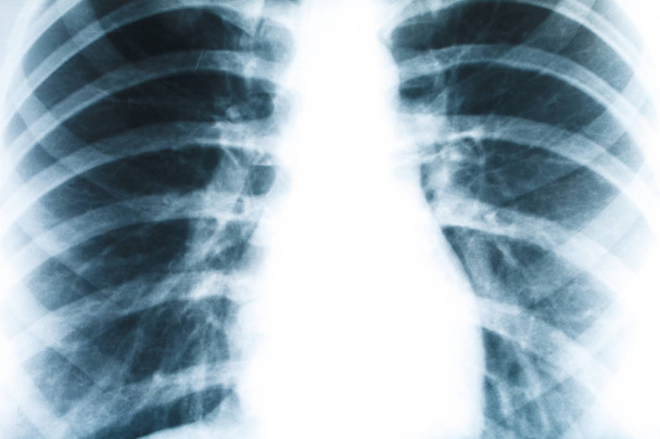 クローズ アップひと肺の x 線写真 - 写真・画像