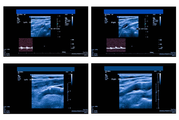 Ultraschallbild der Halsschlagader - Foto, Bild