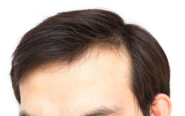 Homem jovem grave problema de perda de cabelo para cuidados de saúde shampoo e conceito de produto de beleza
 - Foto, Imagem
