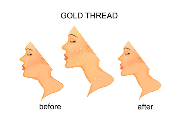 verjonging van het gezicht en de nek met goud draad - Vector, afbeelding
