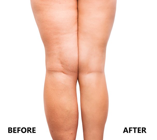 Nogi kobiety, przed i po odchudzaniu - Zdjęcie, obraz