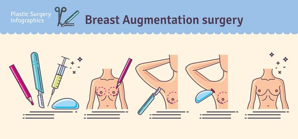 Vector Illustrated set with breast augmentation surgery - Vector, Image
