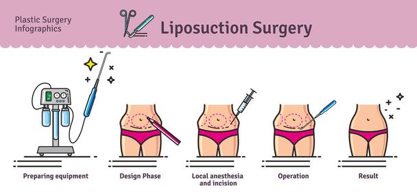 Illustrated vektorové sada s liposukcí chirurgie - Vektor, obrázek