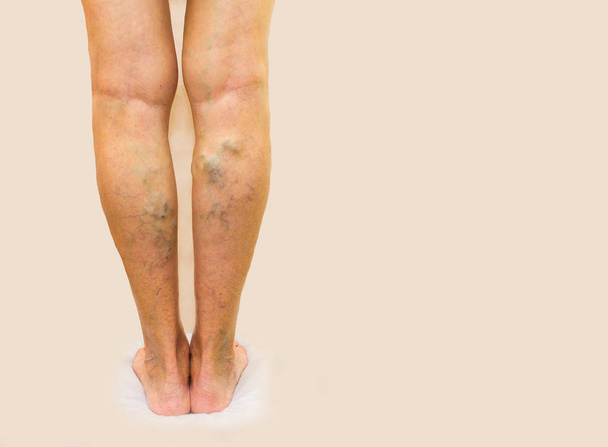 Vene varicose su gambe femminili
 - Foto, immagini