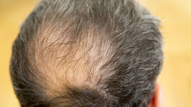 closeup of backside of balding man - Φωτογραφία, εικόνα