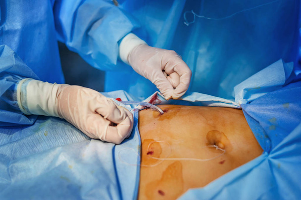 Operation using endoscopy in gynecology - Photo, Image
