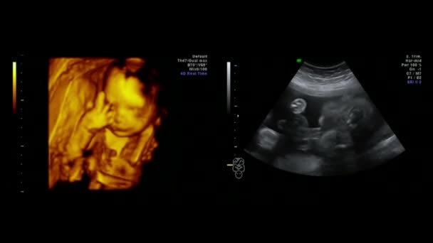 Foetale Sonograms foto 's - Video