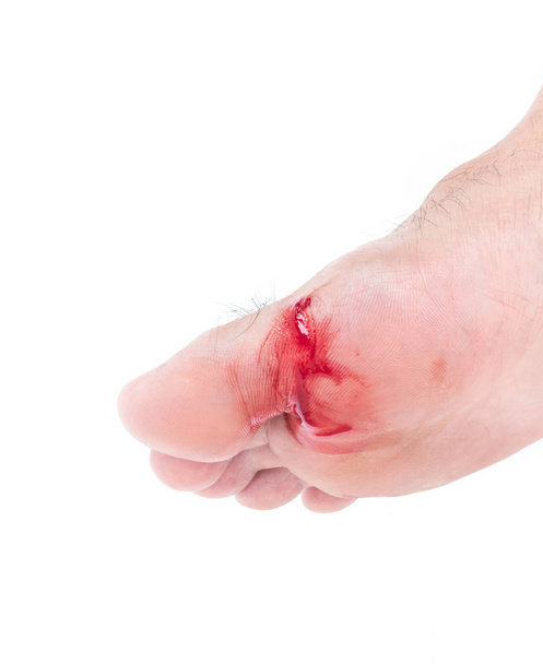 Verletzter Fuß, frische Wunde und Blut aus Glasscherben, weißer Hintergrund - Foto, Bild