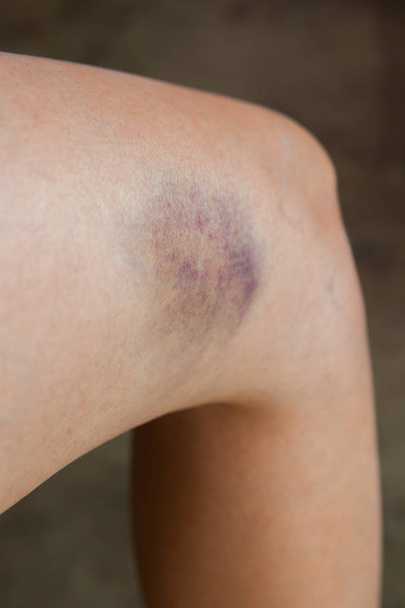 Scratch on the knee caused by a fall. - Фото, зображення