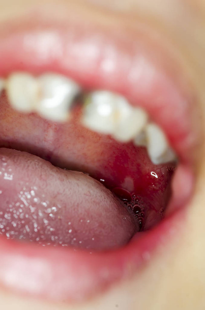 Infecção da úlcera no interior da boca
 - Foto, Imagem