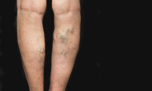 Venas varicosas en piernas femeninas
 - Foto, imagen