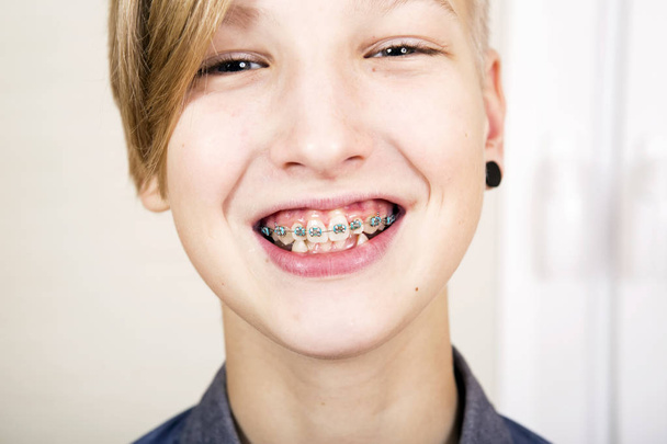 Orthodontics and bite correction. - Photo, Image