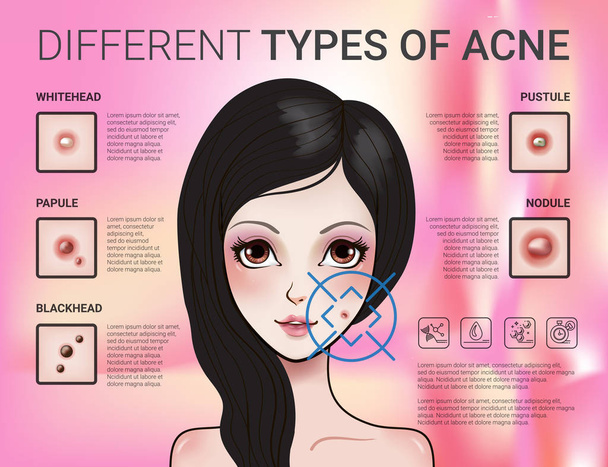 Infographics van verschillend type van acne huid - Vector, afbeelding
