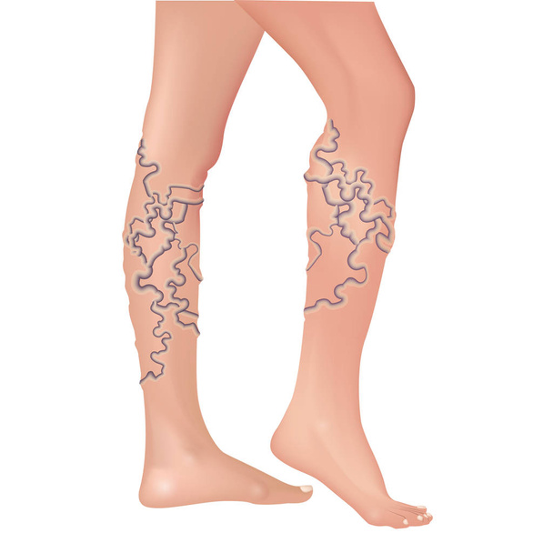 Varicose veins in the legs. - Vector, Image