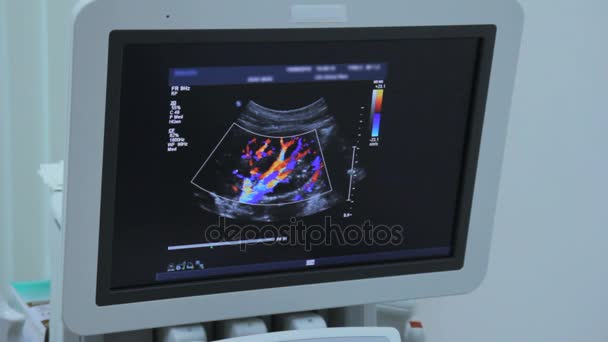 Vasos sanguíneos y arterias coloreadas en el riñón en el monitor para la ecografía
 - Imágenes, Vídeo