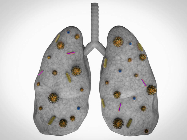 malattia polmonare con cellule batteriche
 - Foto, immagini