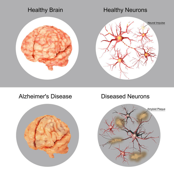 der Patient und das Gehirn gesundes Gehirn und Neuronen im Vergleich - Foto, Bild