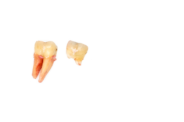 törött fogak eltávolítása a fogszuvasodás, fehér - Fotó, kép