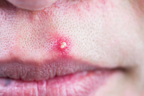 De besmette pustulous acne op het gezicht, selectieve aandacht op acne - Foto, afbeelding