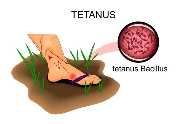 Schäden an den Füßen. das Risiko von Tetanus - Vektor, Bild