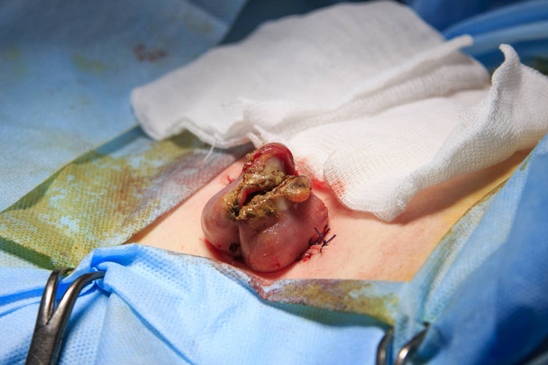 Rectum Sectional With Feces - Photo, Image