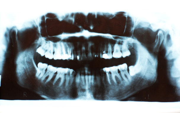 beolvasott kép egy X-ray az emberi fogak - Fotó, kép