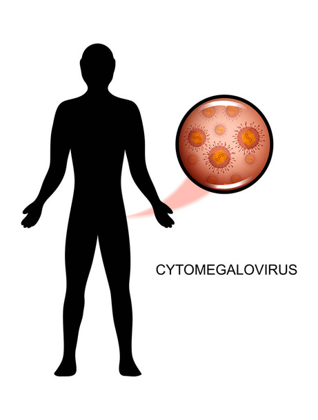 osoba cierpiąca na wirus cytomegalii - Wektor, obraz