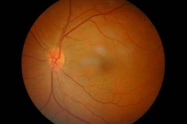 Symtom Augendiabetes. - Foto, Bild