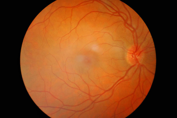 Detail van oog diabetes geïsoleerd - Foto, afbeelding